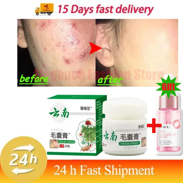Body Acne Removal Cream Treatment Face Butt Back Acne Marks Smooth Repair Chicken Skin Cream Moisturizing Whitening Skin Care