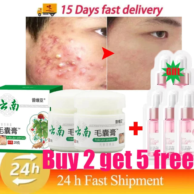 Body Acne Removal Cream Treatment Face Butt Back Acne Marks Smooth Repair Chicken Skin Cream Moisturizing Whitening Skin Care