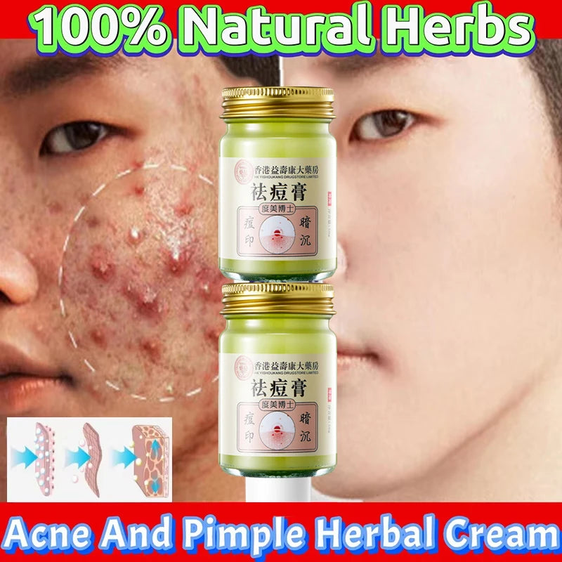 Body Acne Removal Cream Treatment Face Butt Back Acne Marks Smooth Repair Chicken Skin Cream Moisturizing Whitening Skin Care