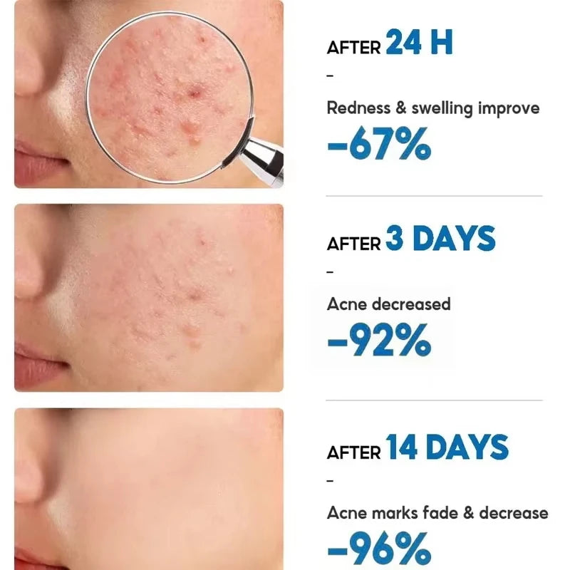 Body Acne Removal Cream Treatment Face Butt Back Acne Marks Smooth Repair Chicken Skin Cream Moisturizing Whitening Skin Care