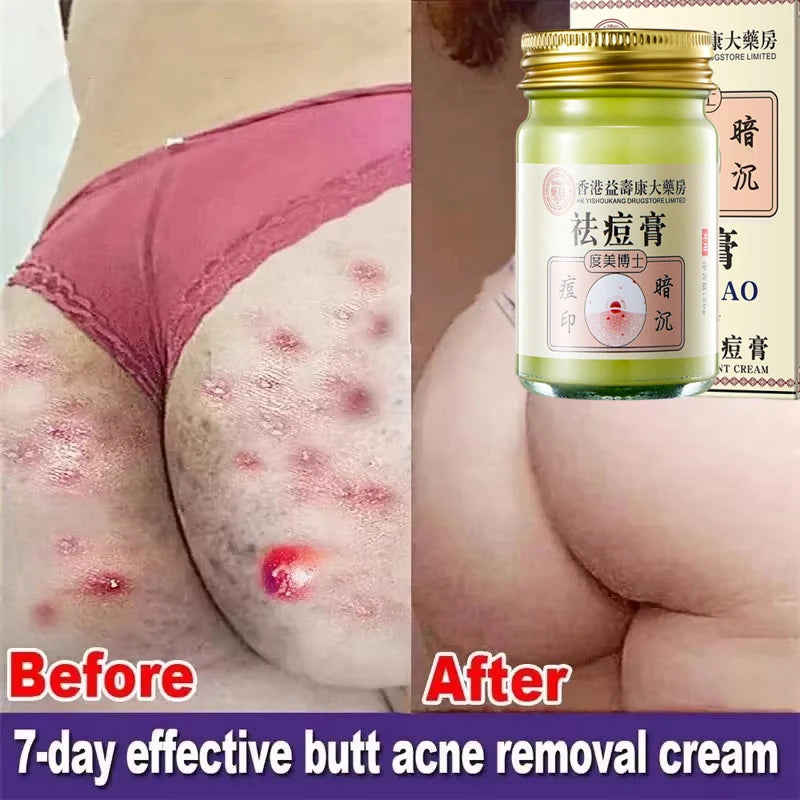 Body Acne Removal Cream Treatment Face Butt Back Acne Marks Smooth Repair Chicken Skin Cream Moisturizing Whitening Skin Care