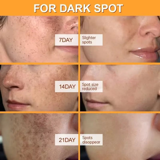 Effective Whitening Freckles Face Cream Dark Spot Corrector Remove Melasma Fade Melanin Pigmentation Brighten Skin Care Products