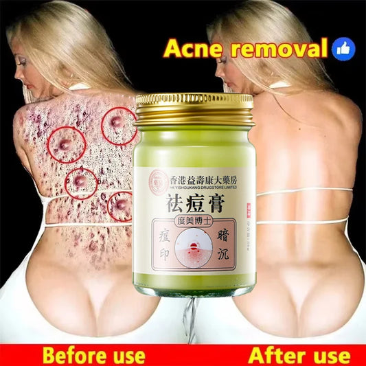 Body Acne Removal Cream Treatment Face Butt Back Acne Marks Smooth Repair Chicken Skin Cream Moisturizing Whitening Skin Care