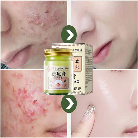 Body Acne Removal Cream Treatment Face Butt Back Acne Marks Smooth Repair Chicken Skin Cream Moisturizing Whitening Skin Care