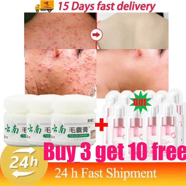 Body Acne Removal Cream Treatment Face Butt Back Acne Marks Smooth Repair Chicken Skin Cream Moisturizing Whitening Skin Care